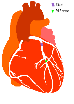 Hj&auml;rtat mitt