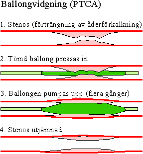 ballongvidgning