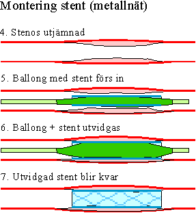 Montering stent